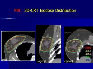 Breast Appearance after MammoSite®3 years post treatment