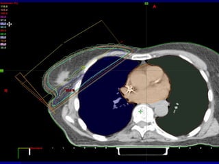 5 – 7 week total treatment durationBreast Irradiation TechniqueExternal BeamTreats “whole breast”Large volume of incidental tissuesRequires protracted (6—7 week) delivery 