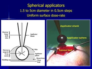 PBI:  3D-CRT Beam Arrangement3.85 Gy BID x 10 fractions