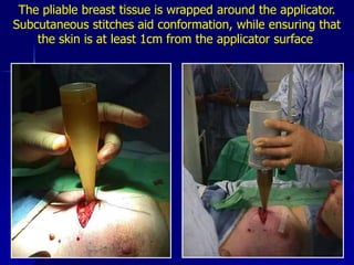 PBI:  3D-CRT Isodose Distribution3850 3752 3655 3557 3460axialsagittalcoronal