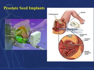 Prostate Seed Implants
 