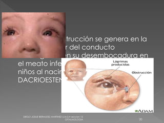 cuando la obstrucción se genera en la 
porción inferior del conducto 
nasolagrimal en su desembocadura en 
el meato inferior, como ocurre en los 
niños al nacimiento, se denomina 
DACRIOESTENOSIS 
DIEGO JOSUE BERMUDEZ MARTINEZ U.M.S.H seccion 12 
OFTALMOLOGIA 20 
 