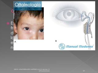  Es la patología observada con mayor 
frecuencia en los niños al nacimiento. Se 
debe a una falta de desarrollo de la vía 
lagrimal, donde existe una obstrucción 
en la desembocadura del conducto 
nasolagrimal hacia el meato inferior. 
DIEGO JOSUE BERMUDEZ MARTINEZ U.M.S.H seccion 12 
OFTALMOLOGIA 21 
 