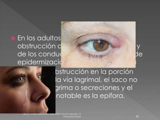  En los adultos también es habitual la 
obstrucción de los puntos lagrimales y 
de los conductillos a consecuencia de 
epidermización o hipertrofia mucosa 
 al estar la obstrucción en la porción 
superior de la vía lagrimal, el saco no 
acumula lágrima o secreciones y el 
único signo notable es la epifora. 
DIEGO JOSUE BERMUDEZ MARTINEZ U.M.S.H seccion 12 
OFTALMOLOGIA 30 
 