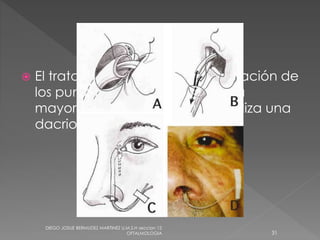  El tratamiento se limita a la dilatación de 
los puntos y conductillos , y en la 
mayoría de las ocasiones se realiza una 
dacriointubación 
DIEGO JOSUE BERMUDEZ MARTINEZ U.M.S.H seccion 12 
OFTALMOLOGIA 31 
 