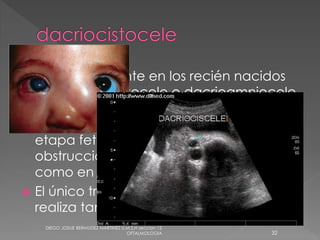  menos frecuente en los recién nacidos 
es el dacriocistocele o dacrioamniocele. 
Corresponde al acúmulo de líquido 
amniótico en el saco lagrimal durante la 
etapa fetal. Se ocasiona por una 
obstrucción tanto en la porción superior 
como en la inferior de la vía. 
 El único tratamiento es el sondeo, que se 
realiza tan pronto se hace el diagnóstico 
DIEGO JOSUE BERMUDEZ MARTINEZ U.M.S.H seccion 12 
OFTALMOLOGIA 32 
 