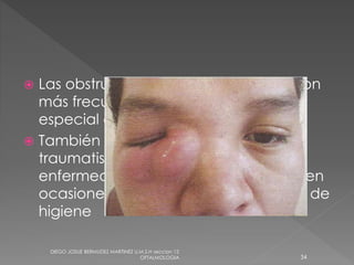  Las obstrucciones de la vía lagrimal son 
más frecuentes en mujeres (4:1), en 
especial después de la menopausia. 
 También puede relacionarse con 
traumatismos orbitonasales, 
enfermedades de la mucosa nasal y en 
ocasiones con defectos en las rutinas de 
higiene 
DIEGO JOSUE BERMUDEZ MARTINEZ U.M.S.H seccion 12 
OFTALMOLOGIA 34 
 