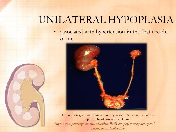 Renal Hypoplasia FINAL OUTPUT by Nica Valencia