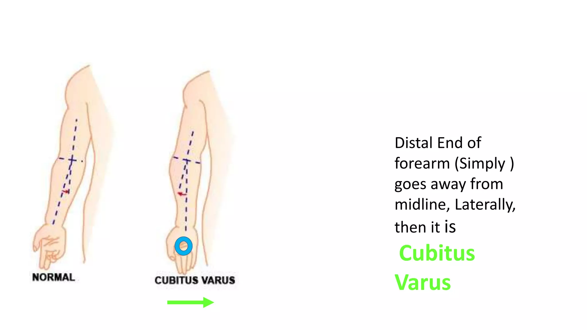 Distal End of
forearm (Simply )
goes towards
midline, Medially,
then it is
Cubitus
Varus