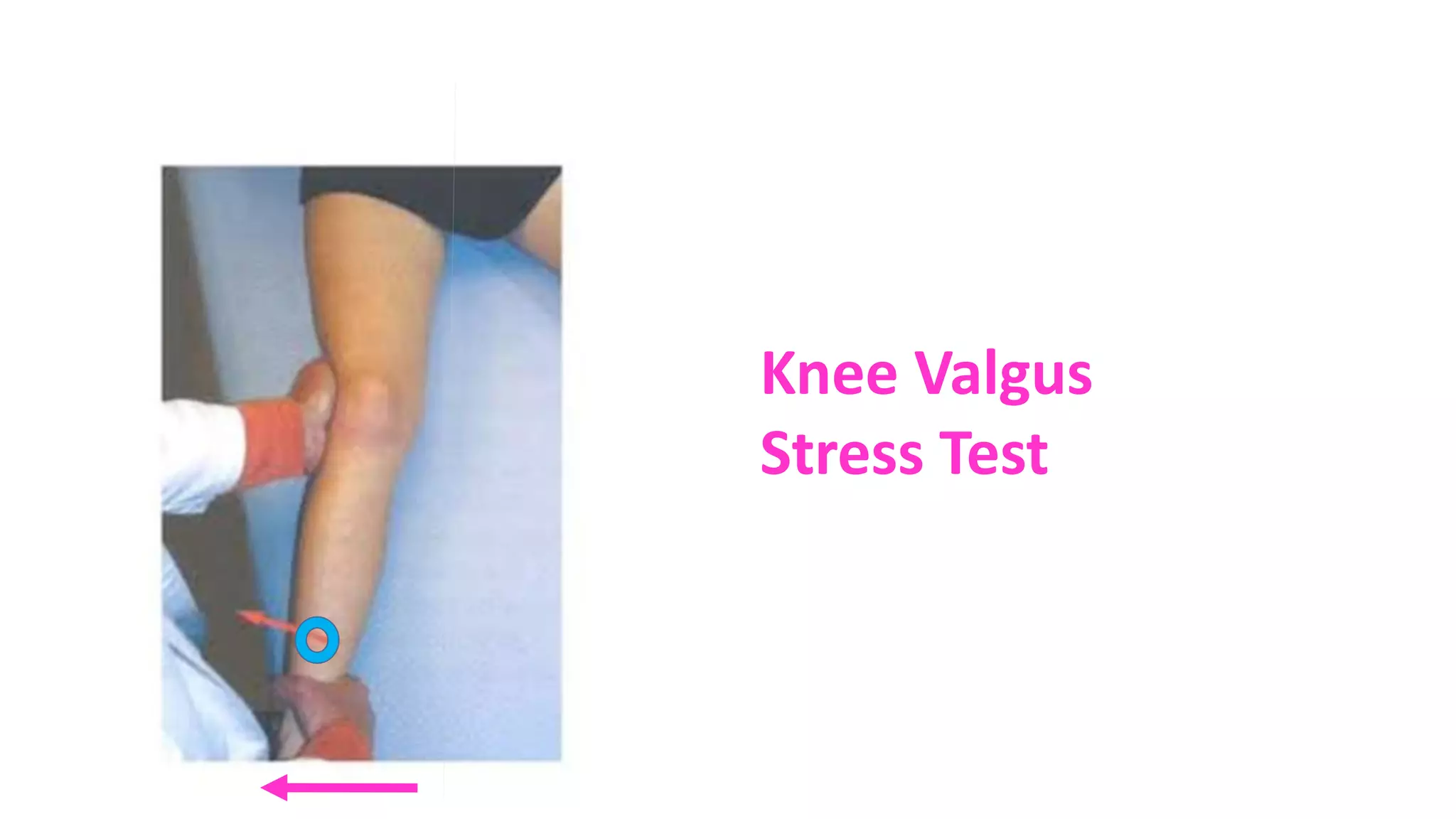 Knee Valgus
Stress Test