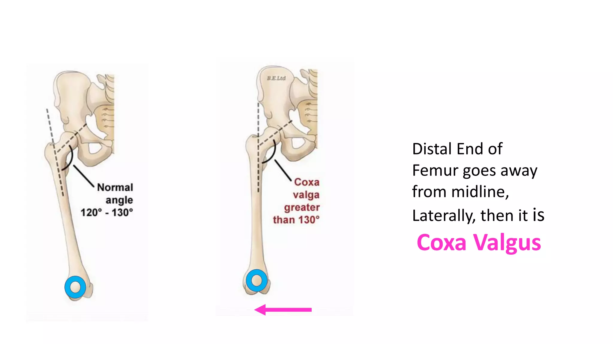 Distal End of
Femur goes away
from midline,
Laterally, then it is
Coxa Valgus