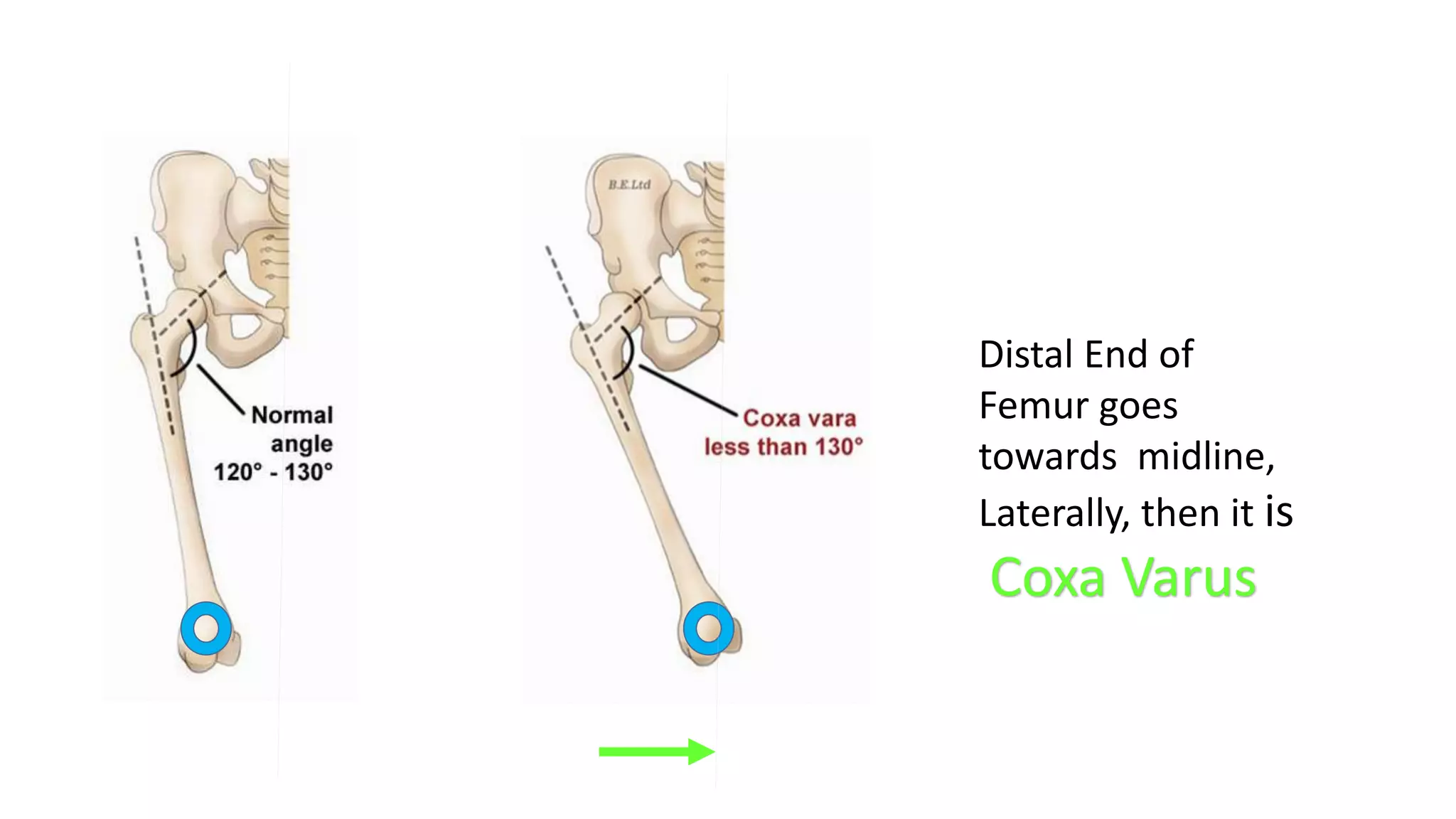 Distal End of
Femur goes
towards midline,
Medially, then it is
Coxa Varus