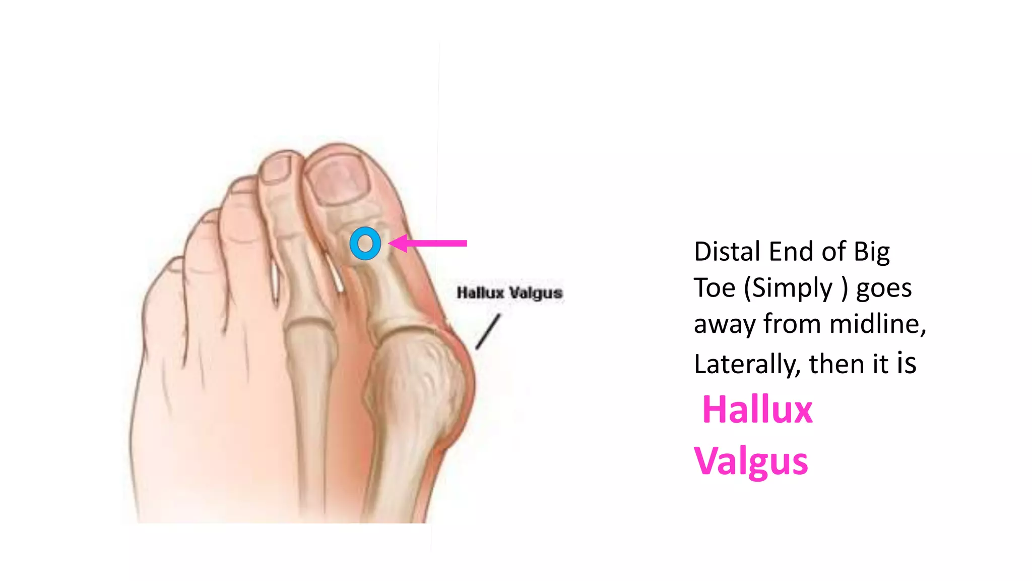 Distal End of Big
Toe (Simply ) goes
away from midline,
Laterally, then it is
Hallux
Valgus