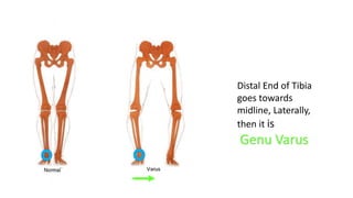 Valgus vs. Varus | PPT