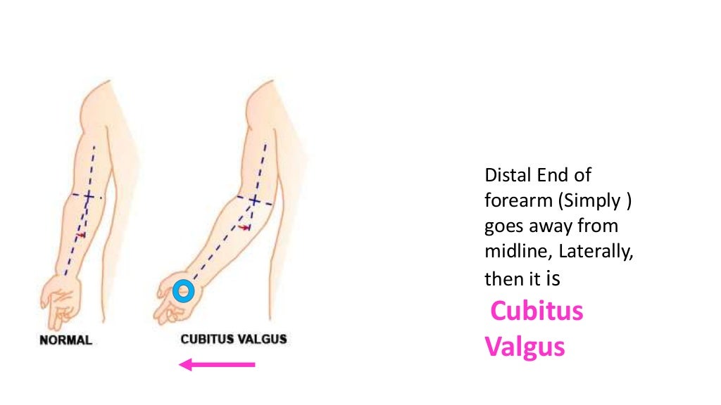 Valgus vs. Varus