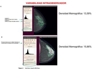 Densidad Mamográfica: 13,59%
Densidad Mamográfica: 15,86%
VARIABILIDAD INTRAOBSERVADOR
 