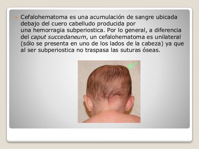 nacido cefalohematoma recien hueso pediatr parietal