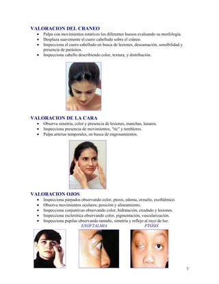 VALORACION DEL CRANEO
  •   Palpa con movimientos rotativos los diferentes huesos evaluando su morfología.
  •   Desplaza suavemente el cuero cabelludo sobre el cráneo.
  •   Inspecciona el cuero cabelludo en busca de lesiones, descamación, sensibilidad y
      presencia de parásitos.
  •   Inspecciona cabello describiendo color, textura, y distribución.




VALORACION DE LA CARA
  •   Observa simetría, color y presencia de lesiones, manchas, lunares.
  •   Inspecciona presencia de movimientos, "tic" y temblores.
  •   Palpa arterias temporales, en busca de engrosamientos.




VALORACION OJOS
  •   Inspecciona párpados observando color, ptosis, edema, orzuelo, exoftálmico.
  •   Observa movimientos oculares; posición y alineamiento.
  •   Inspecciona conjuntivas observando color, hidratación, exudado y lesiones.
  •   Inspecciona esclerótica observando color, pigmentación, vascularización.
  •   Inspecciona pupilas observando tamaño, simetría y reflejo al rayo de luz.
                            EXOFTALMIA                          PTOSIS




                                                                                         7
 