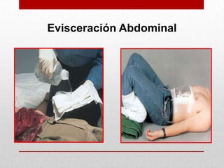 AplastamientoDaño a tejidos blandos y órganos internos