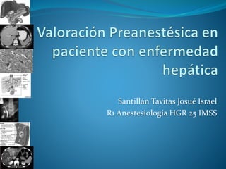 Santillán Tavitas Josué Israel
R1 Anestesiología HGR 25 IMSS
 