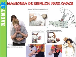 SIGNO UNIVERSAL DE ASFIXIA
 