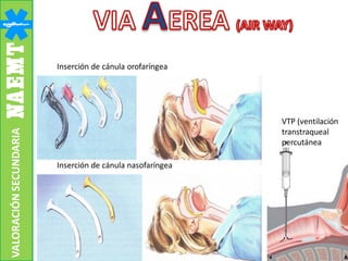 VTP (ventilación
transtraqueal
percutánea
Inserción de cánula orofaríngea
Inserción de cánula nasofaríngea
VALORACIÓNSECUNDARIA
 