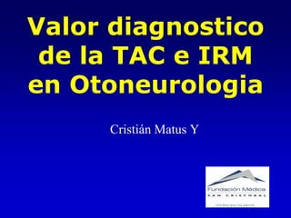 Valor diagnostico
 de la TAC e IRM
en Otoneurologia
     Cristián Matus Y
 