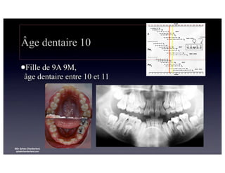 Âge dentaire 10
lFille

de 9A 9M,
âge dentaire entre 10 et 11

©Dr Sylvain Chamberland,
sylvainchamberland.com

 