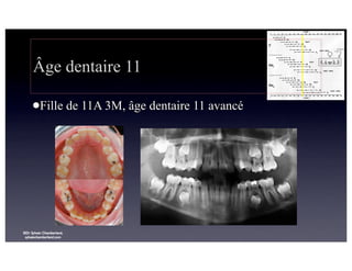 Âge dentaire 11
lFille

©Dr Sylvain Chamberland,
sylvainchamberland.com

de 11A 3M, âge dentaire 11 avancé

 