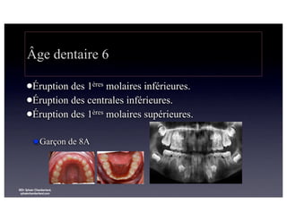 Âge dentaire 6
lÉruption

des 1ères molaires inférieures.
lÉruption des centrales inférieures.
lÉruption des 1ères molaires supérieures.
★Garçon de 8A

©Dr Sylvain Chamberland,
sylvainchamberland.com

 