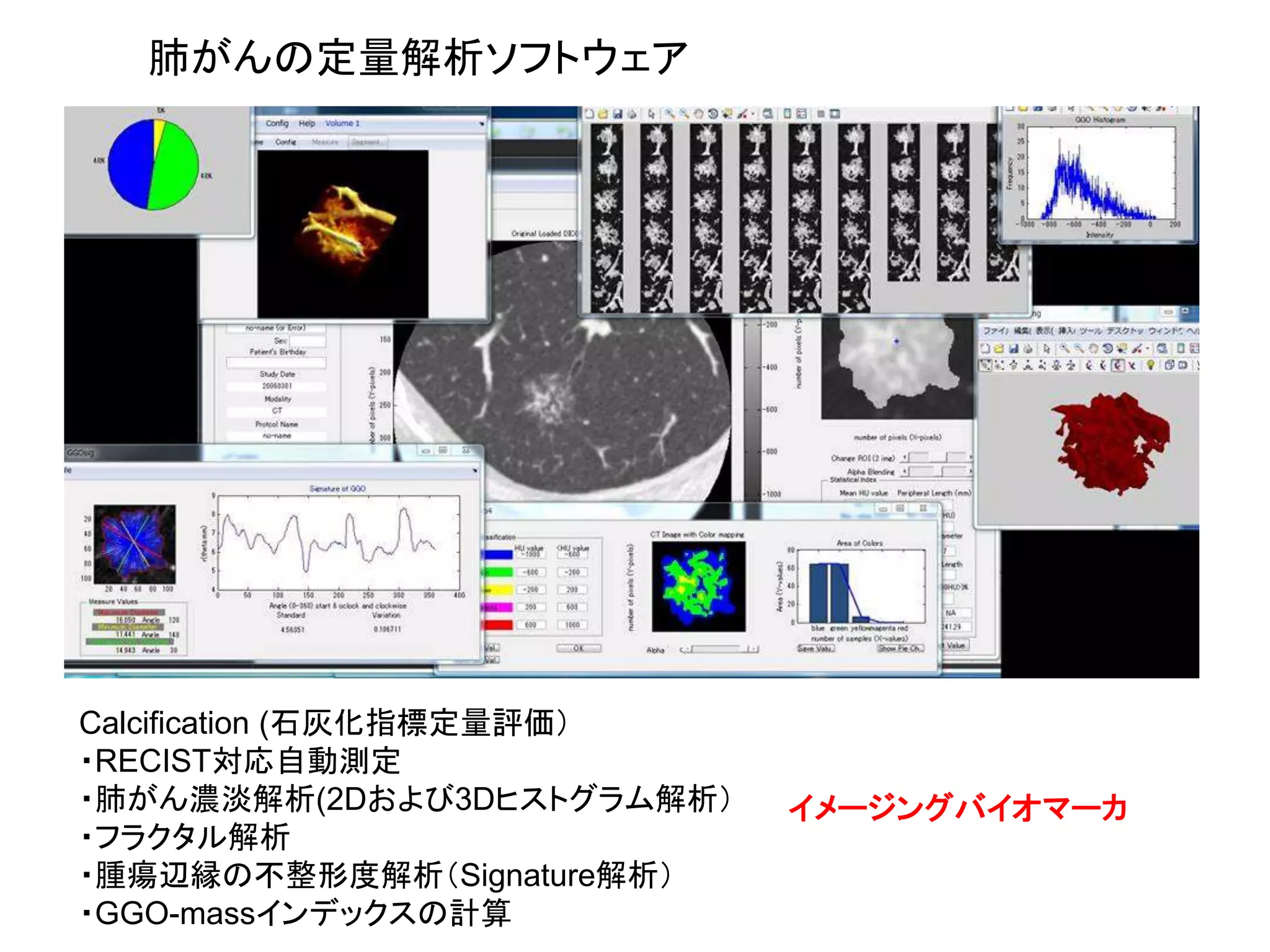 肺がんの定量解析ソフトウェア
Calcification (石灰化指標定量評価）
・RECIST対応自動測定
・肺がん濃淡解析(2Dおよび3Dヒストグラム解析）
・フラクタル解析
・腫瘍辺縁の不整形度解析（Signature解析）
・GGO-massインデックスの計算
イメージングバイオマーカ
 