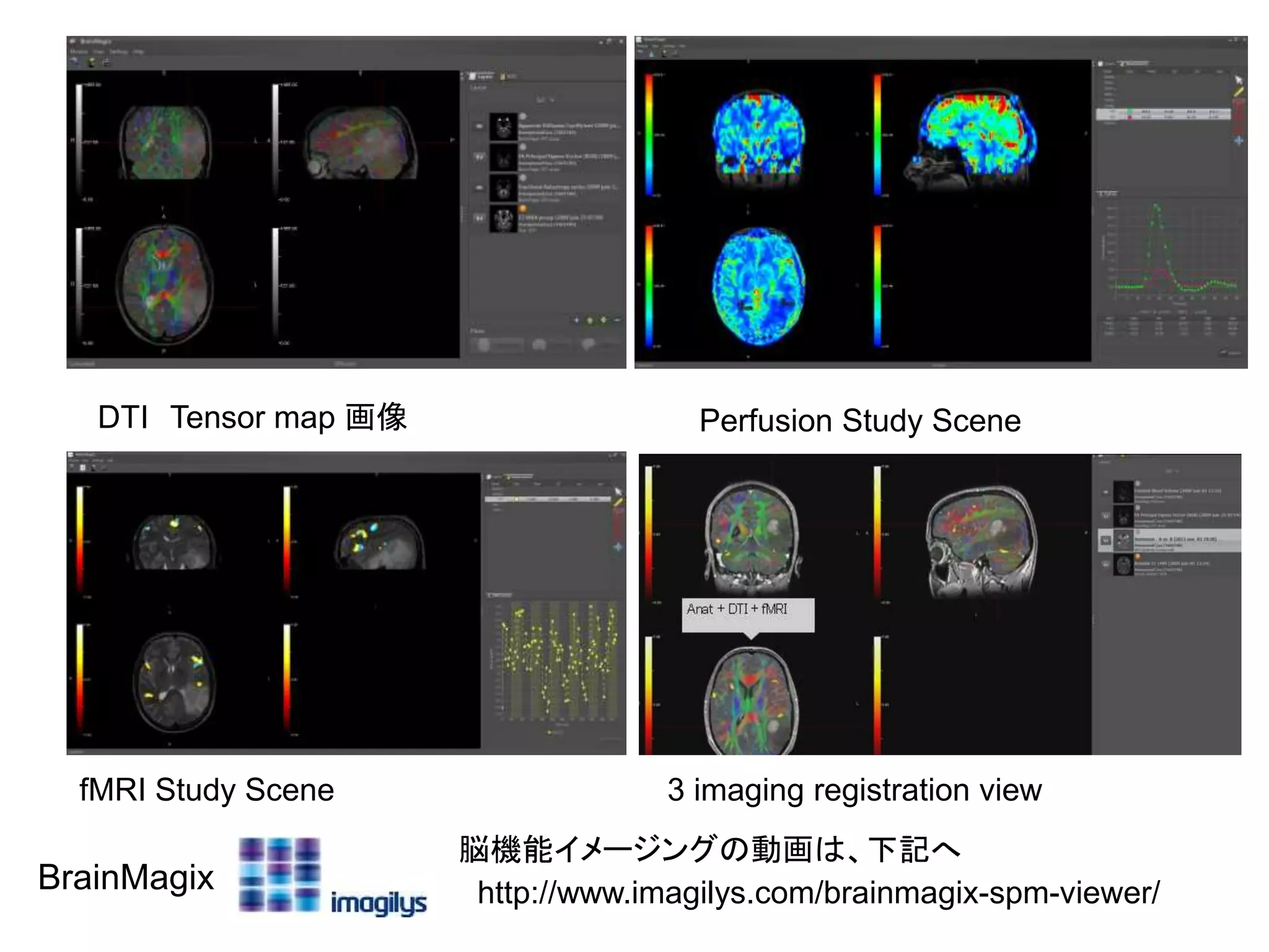 http://www.imagilys.com/brainmagix-spm-viewer/
脳機能イメージングの動画は、下記へ
DTI Tensor map 画像 Perfusion Study Scene
fMRI Study Scene 3 imaging registration view
BrainMagix
 