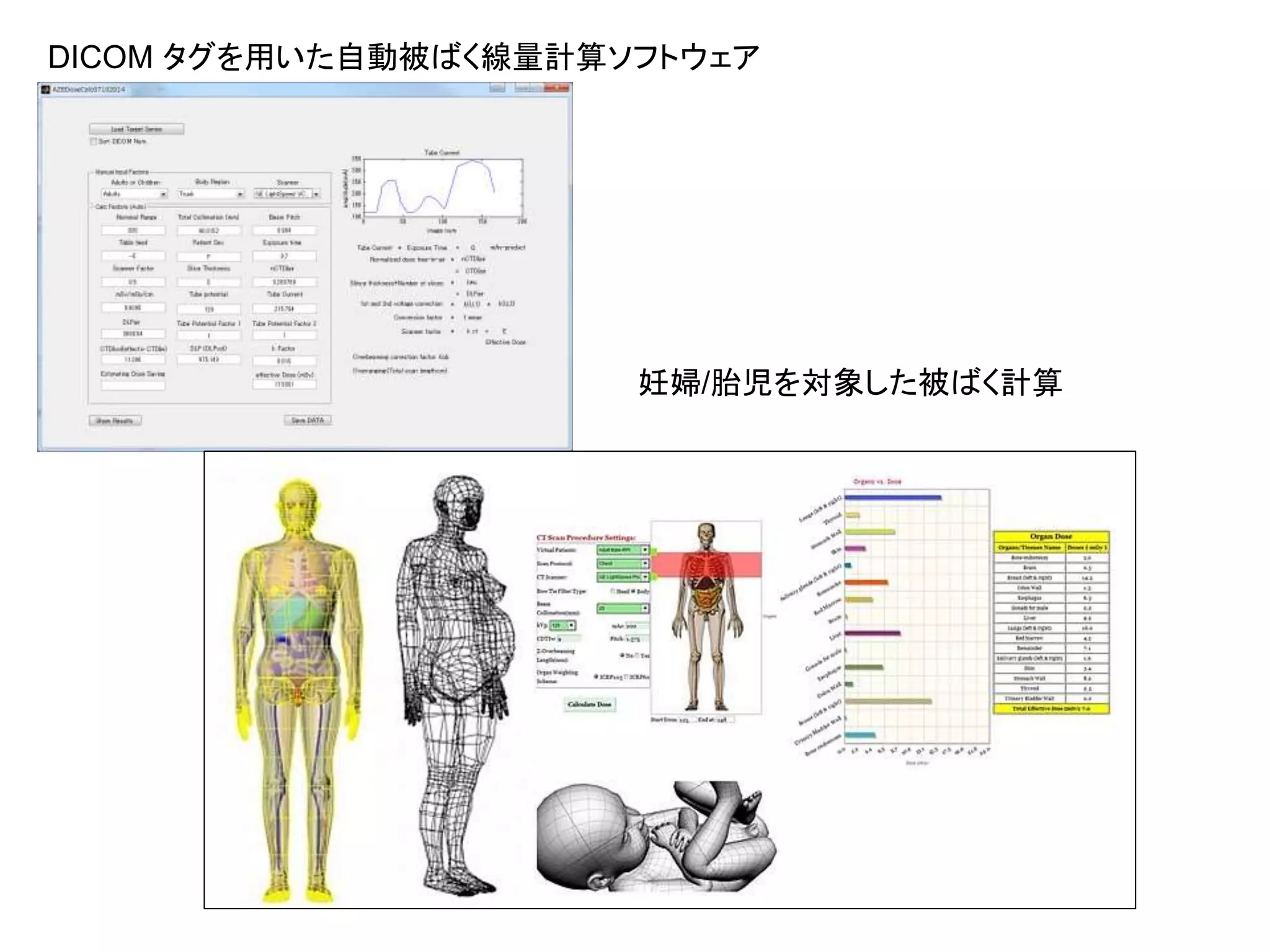 DICOM タグを用いた自動被ばく線量計算ソフトウェア
妊婦/胎児を対象した被ばく計算
 