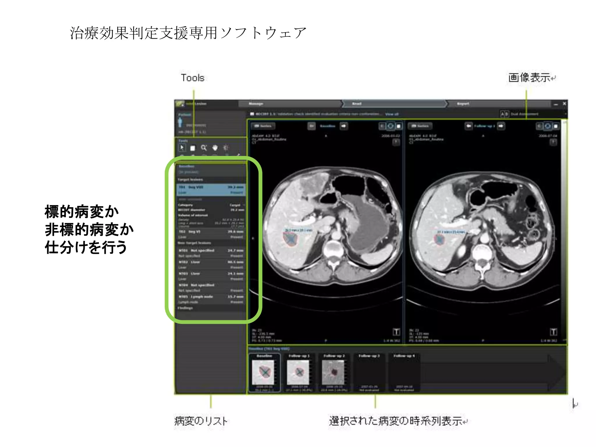 標的病変か
非標的病変か
仕分けを行う
治療効果判定支援専用ソフトウェア
 