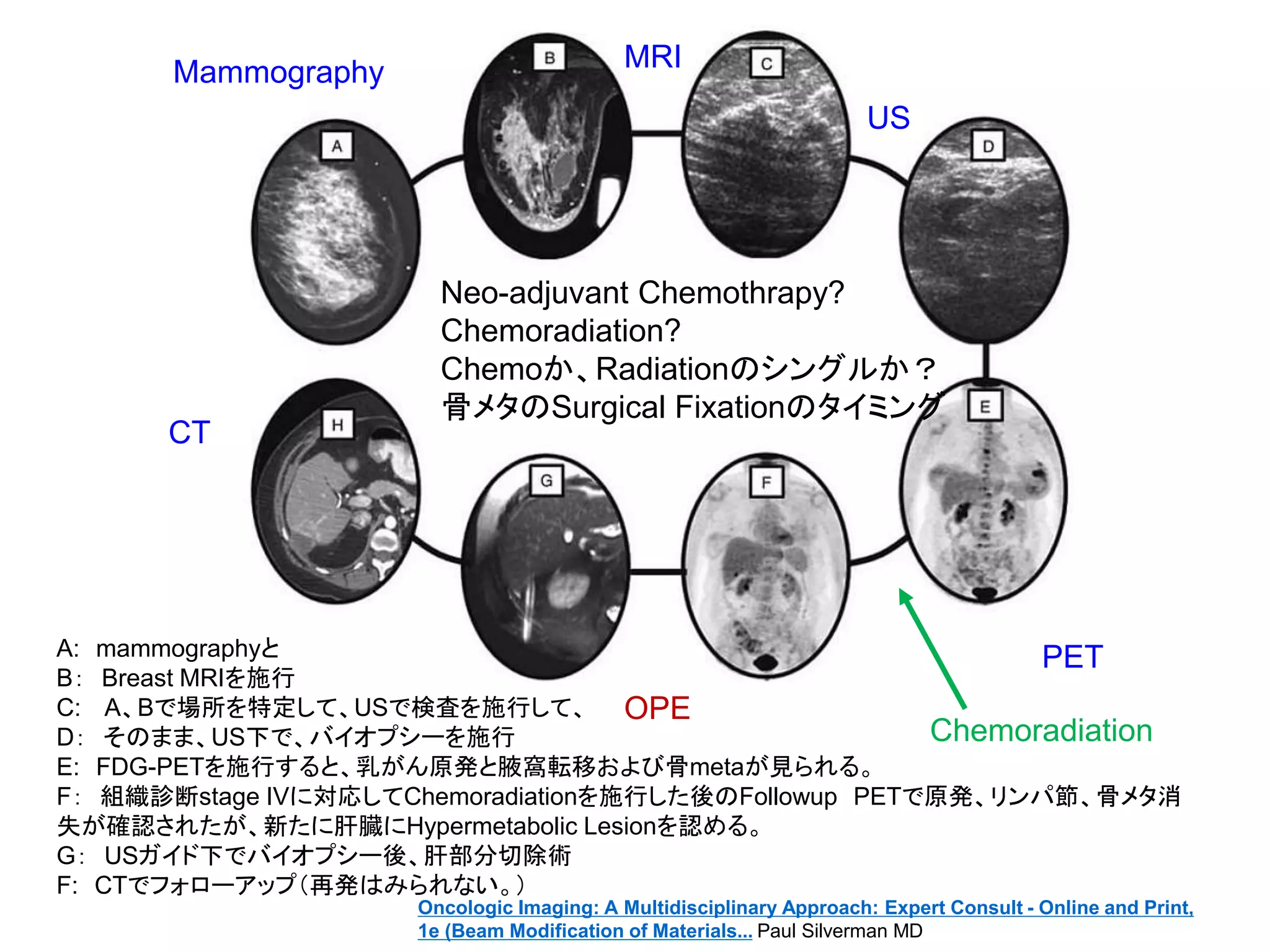 A: mammographyと
B： Breast MRIを施行
C: A、Bで場所を特定して、USで検査を施行して、
D： そのまま、US下で、バイオプシーを施行
E: FDG-PETを施行すると、乳がん原発と腋窩転移および骨metaが見られる。
F： 組織診断stage IVに対応してChemoradiationを施行した後のFollowup PETで原発、リンパ節、骨メタ消
失が確認されたが、新たに肝臓にHypermetabolic Lesionを認める。
G： USガイド下でバイオプシー後、肝部分切除術
F: CTでフォローアップ（再発はみられない。）
Neo-adjuvant Chemothrapy?
Chemoradiation?
Chemoか、Radiationのシングルか？
骨メタのSurgical Fixationのタイミング
Mammography MRI
US
CT
PET
Chemoradiation
OPE
Oncologic Imaging: A Multidisciplinary Approach: Expert Consult - Online and Print,
1e (Beam Modification of Materials... Paul Silverman MD
 
