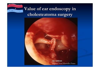 Value of ear endoscopy in
 cholesteatoma surgery




             Ali ABBAS
             Hôpital Nord Marseilles France
 