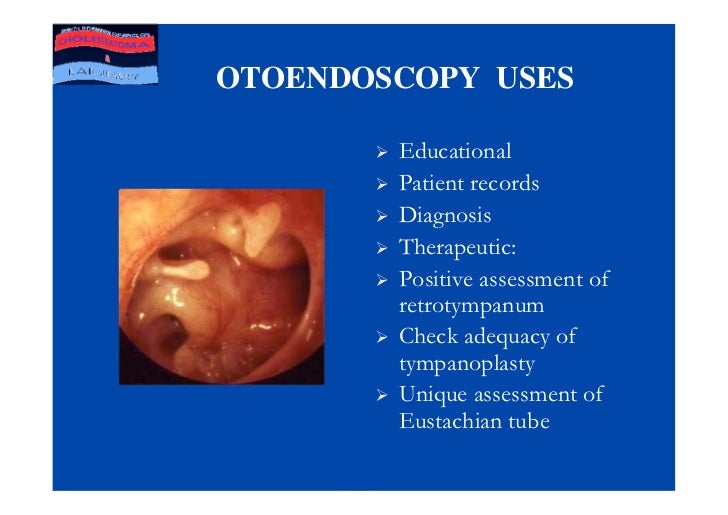 Value Of Ear Endoscopy In Cholesteatoma Surgery.Ppt
