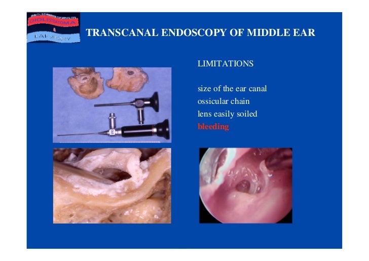 Value Of Ear Endoscopy In Cholesteatoma Surgery.Ppt