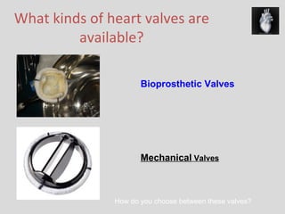 What kinds of heart valves are available? Bioprosthetic Valves Mechanical  Valves How do you choose between these valves? 