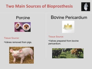 Two Main Sources of Bioprosthesis  Bov ine Pericardium Tissue Source: Valves removed from pigs. Tissue Source: Valves prepared from bovine pericardium. Porcine 