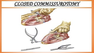 CLOSED COMMISSUROTOMY
 