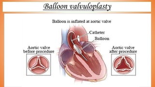 Balloon valvuloplasty
 