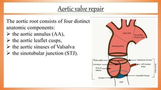 Aortic valve repair
The aortic root consists of four distinct
anatomic components:
 the aortic annulus (AA),
 the aortic leaflet cusps,
 the aortic sinuses of Valsalva
 the sinotubular junction (STJ).
 
