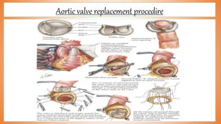 Aortic valve replacement procedire
 