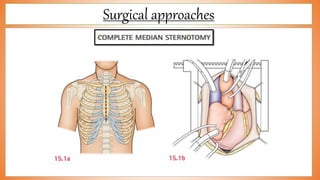 Surgical approaches
 