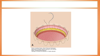 valve replacement and reconstruction.pptx