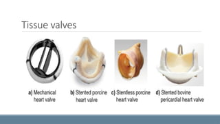VALVE SURGERIES.pptx jklllllgxzsssbmkbmvcc | PPTX