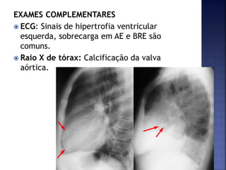 EXAMES COMPLEMENTARES
 ECG: Sinais de hipertrofia ventricular
esquerda, sobrecarga em AE e BRE são
comuns.
 Raio X de tórax: Calcificação da valva
aórtica.
 