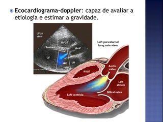  Ecocardiograma-doppler: capaz de avaliar a
etiologia e estimar a gravidade.
 