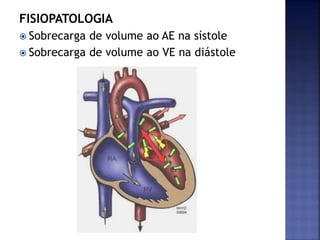 FISIOPATOLOGIA
 Sobrecarga de volume ao AE na sístole
 Sobrecarga de volume ao VE na diástole
 